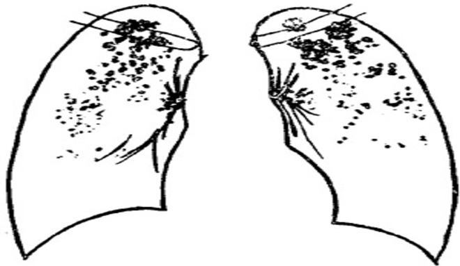 怀疑肺结核一定要查三次痰吗,医生怀疑是肺结核的几率有多大