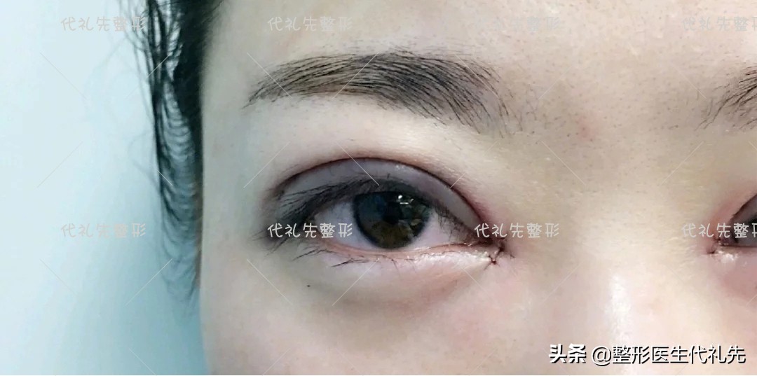 新月双眼皮怎样改扇形,聊双眼皮话术