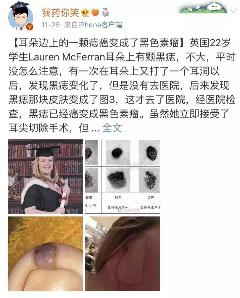 长在什么部位的痣最危险,长在哪些部位的痣需要特别注意
