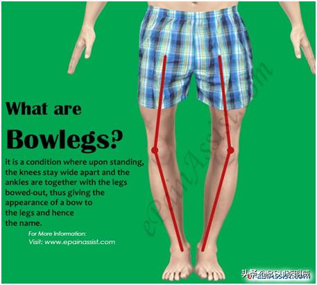 站着矫正o型腿的方法,o型腿矫正神器