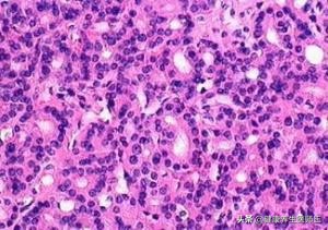 外阴良性肿瘤的症状,外阴良性肿瘤暂时不做手术可以吗