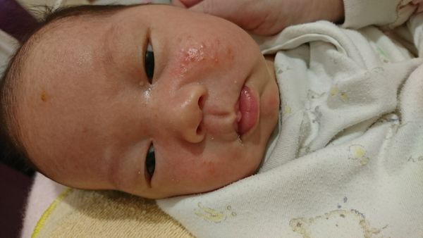 脂溢性皮炎脸部护理,脂溢性皮炎最简单自愈方法婴儿