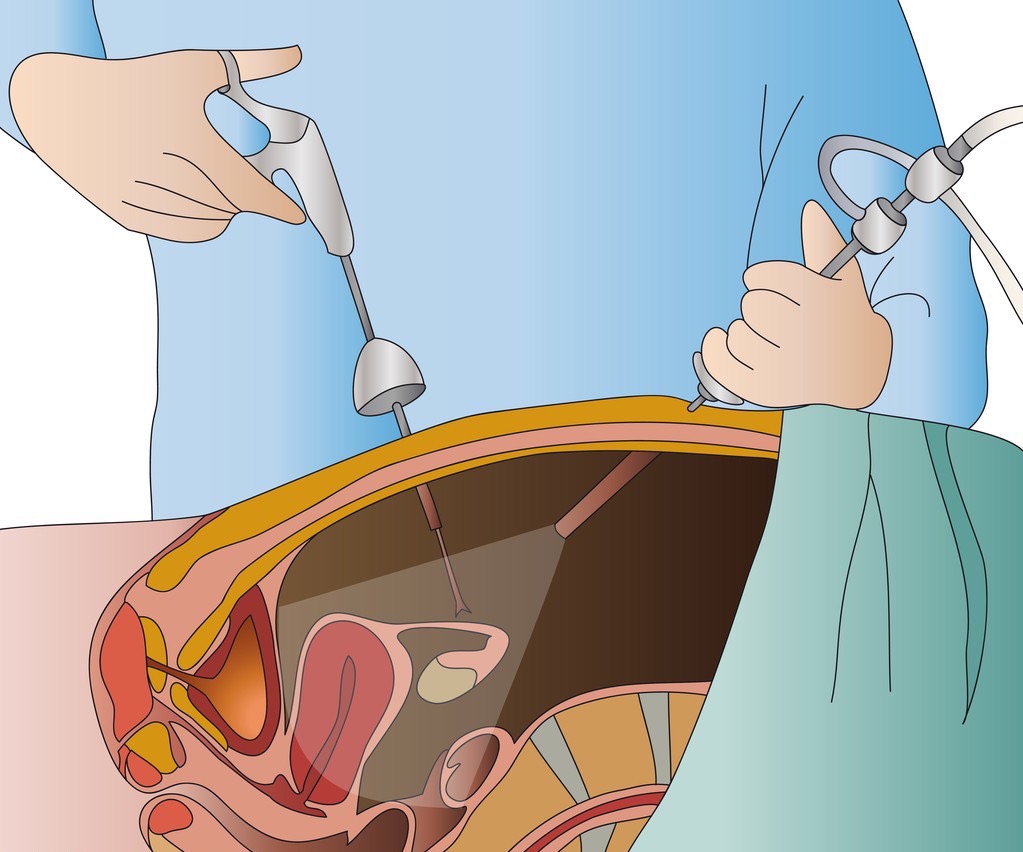 未婚卵巢囊肿怎么治疗比较好,患者具有巨大卵巢囊肿