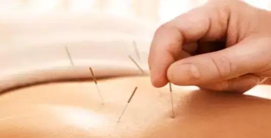 针灸治疗疼痛的偏方,针灸治疗腰疼痛的偏方