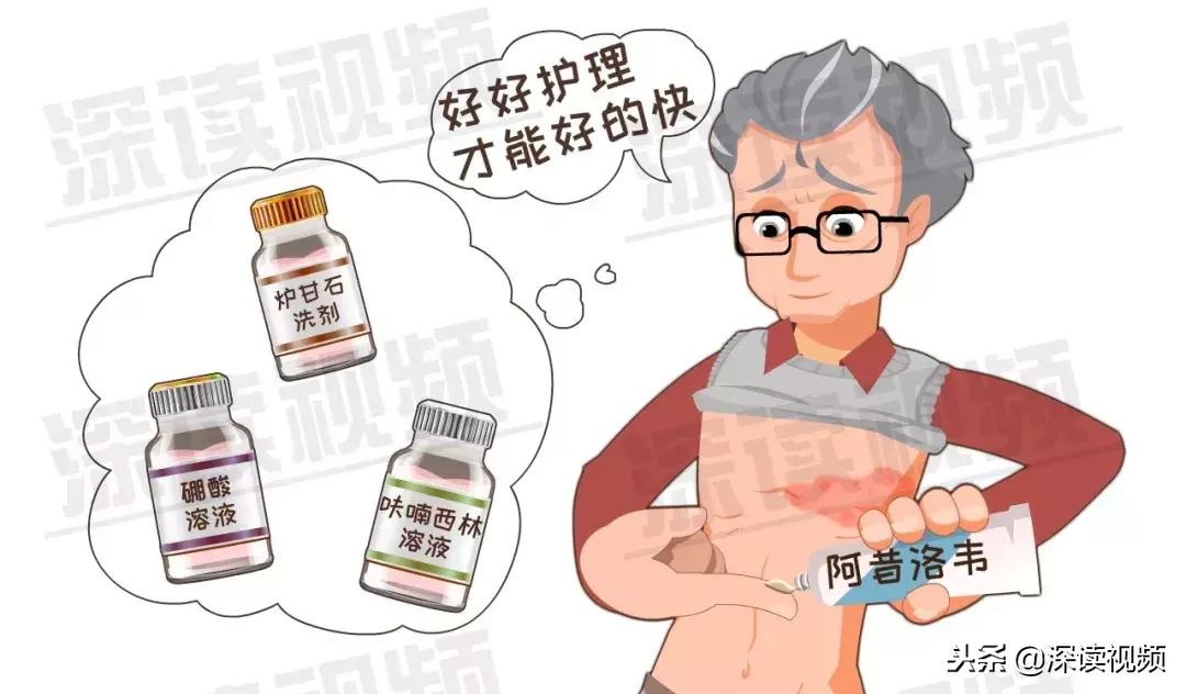 水痘和带状疱疹的关系你了解多少,水痘病毒引起的疱疹