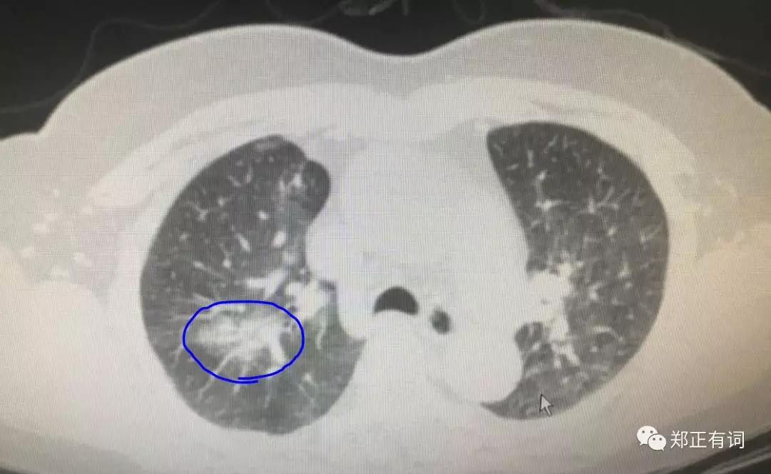 心肺功能特差的肺癌病人,肺癌病人怎么提高心肺功能