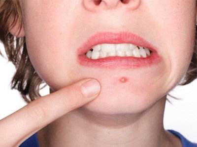 如何让脸上不要反反复复长痘,要想不长痘不能吃什么