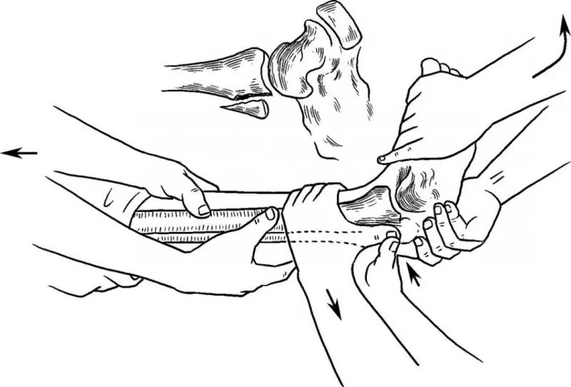 骨折闭合复位髓内钉内固定术,骨折闭合复位