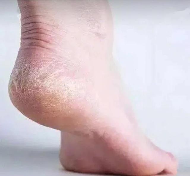 脚后跟干裂脱皮教你一招实用省钱,脚后跟总是干裂起皮的人注意
