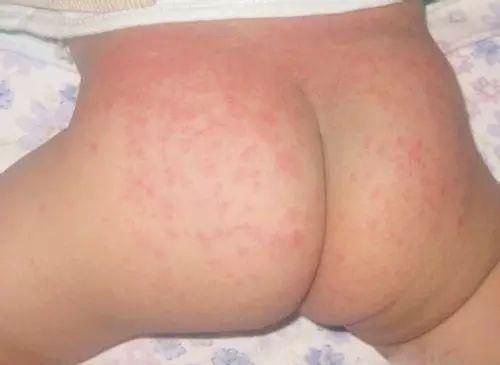 宝宝红屁股怎么办？杜绝宝宝红屁股，预防和护理方法都有了