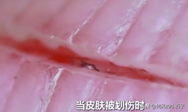 人受伤后伤口怎么愈合?显微镜放大100倍,看完长见识了