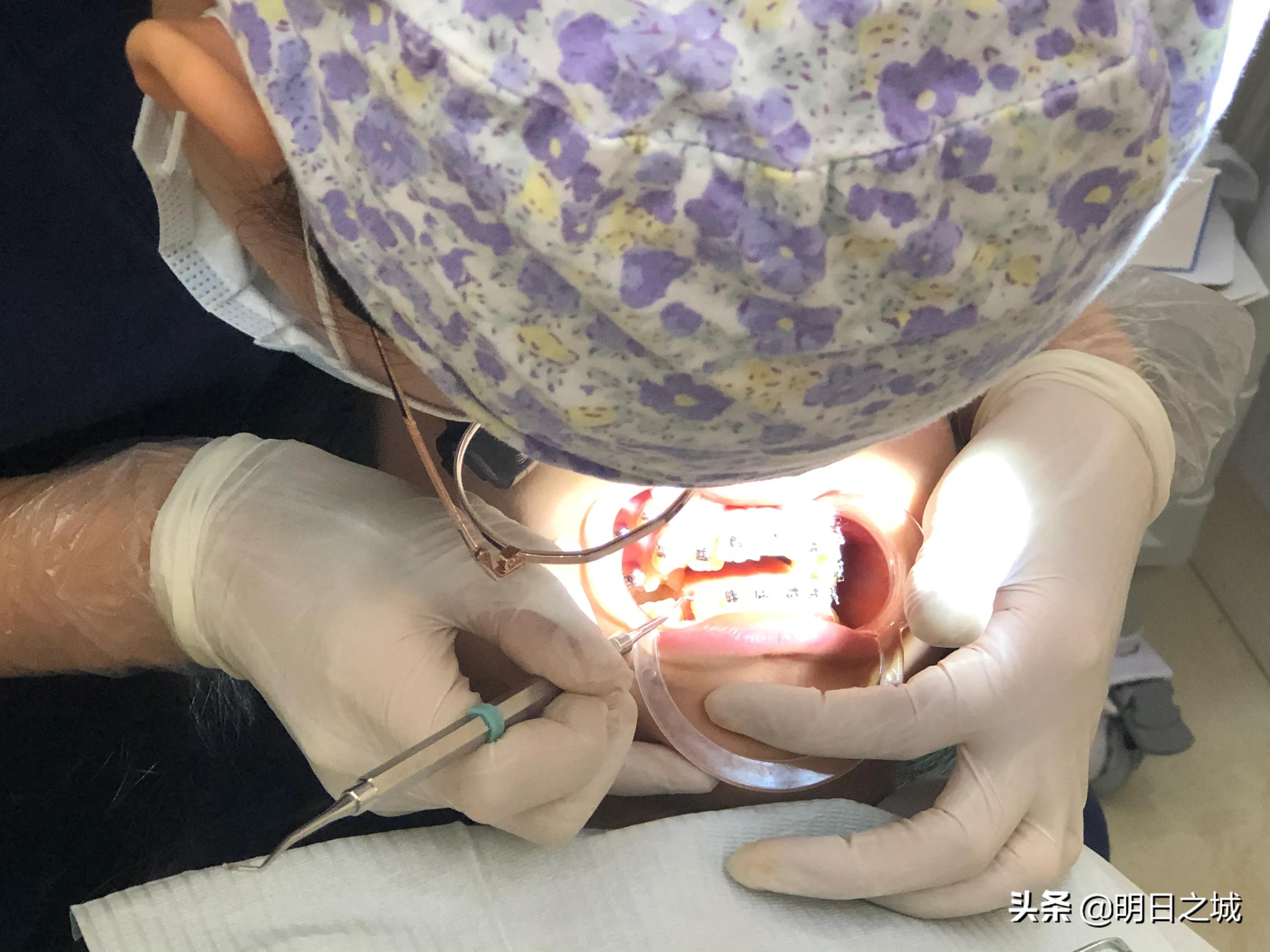 15岁女生矫正牙齿戴牙套全过程,12岁女孩牙齿矫正四颗牙一起拔牙