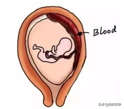 孕妇中期突然腹痛一下,孕妇强忍阵痛走路