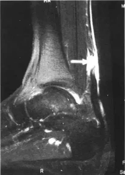 运动医学分析运动损伤案例,运动医学跟腱撕裂
