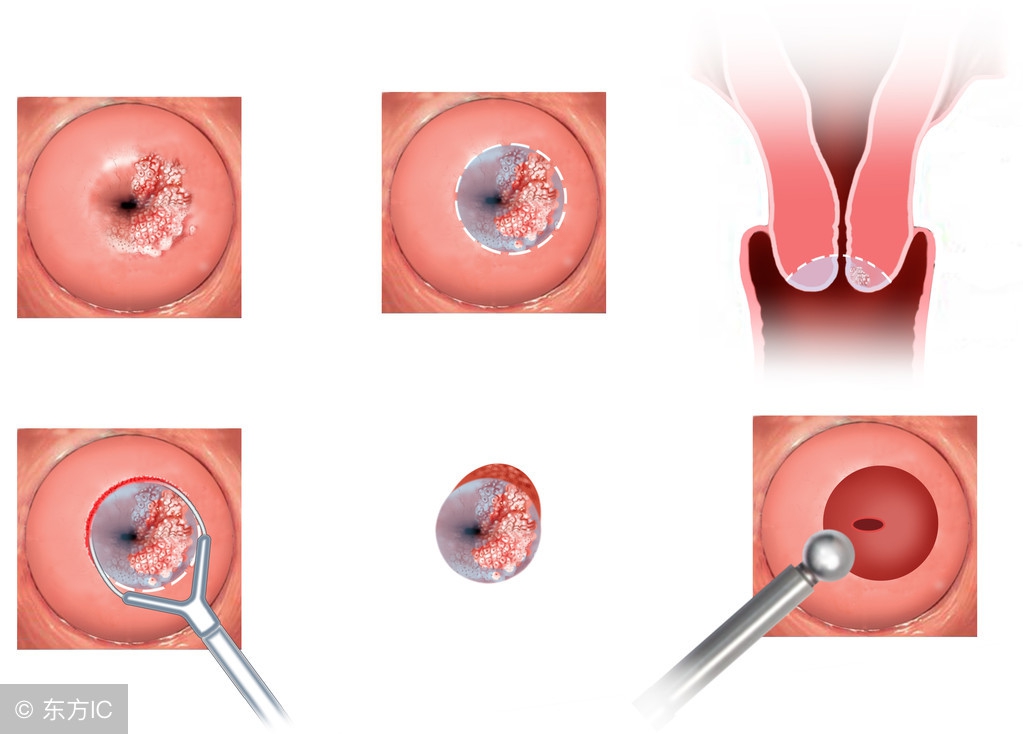 宫颈糜烂：妇科最泛滥的疾病