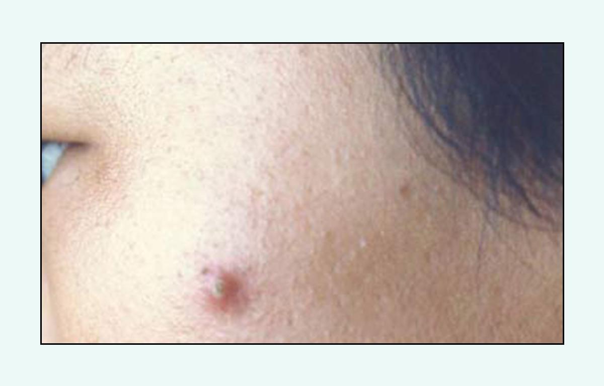 脸上的红疙瘩怎么彻底消除,脸上红疙瘩的种类