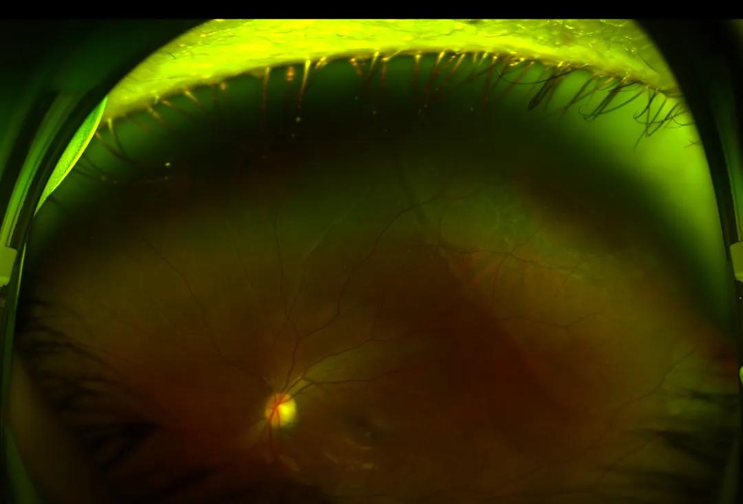 眼前突然出现黑影还很难受,眼前总有黑影飘是怎么了