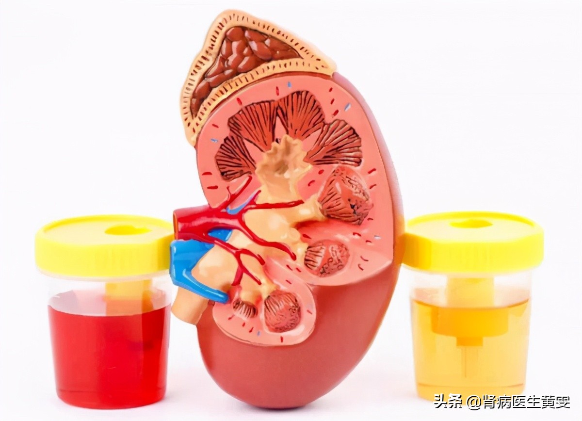 我是如何临床治愈iga肾病的,女性肾病吃什么药