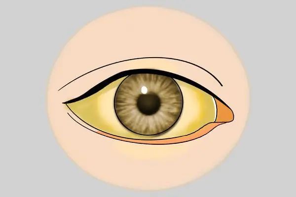 吃生鱼片容易得什么肝炎,吃生鱼片对肝脏有什么影响