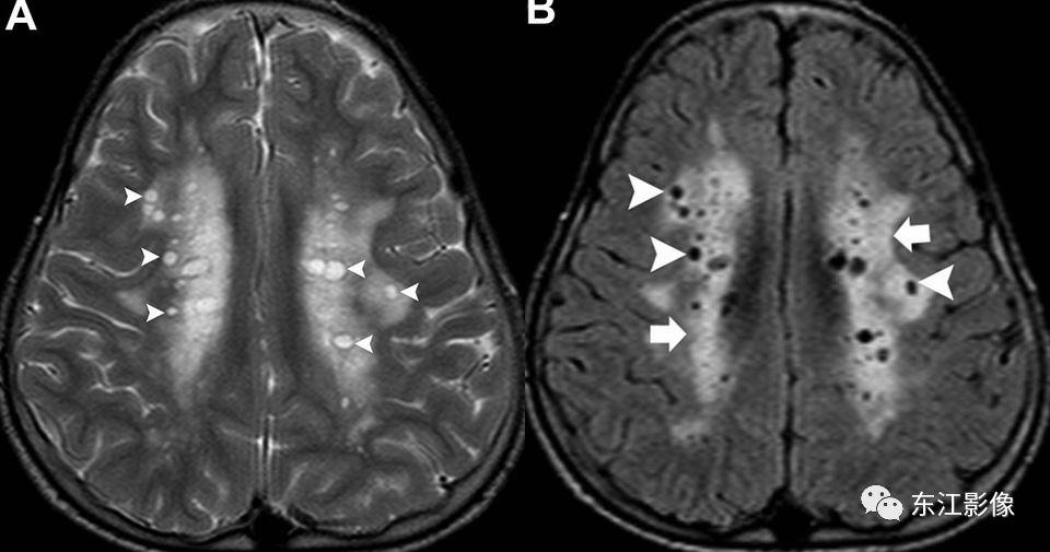 头颅mri扫描影像哪里找,头颅影像mra详细解说