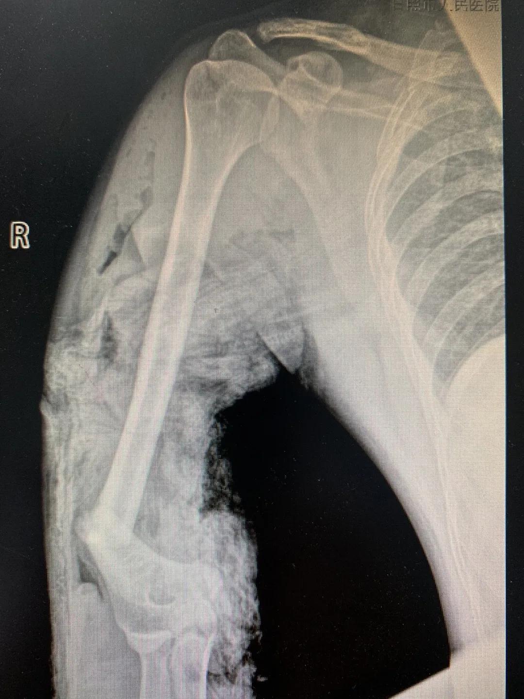 【日照市人民医院】右臂卷入机器被撕裂　6.5小时成功复活