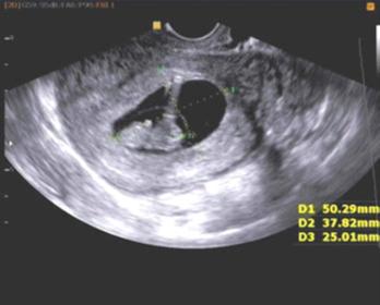 20岁做了无痛人流,意外怀孕去医院人流