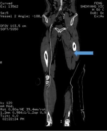 下肢动脉栓塞介入治疗后复发手术,下肢血管大面积栓塞怎么治