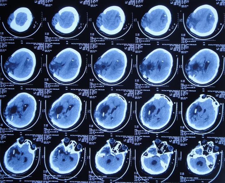 脑室有粘连脑积水有什么办法,脑动脉畸形手术后出现急性脑积水