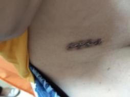 术后伤口要祛疤膏吗,术后伤口拆线后伤口好周围红