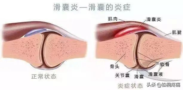 女人膝盖疼痛警惕四种病因,膝盖内侧疼痛的病因