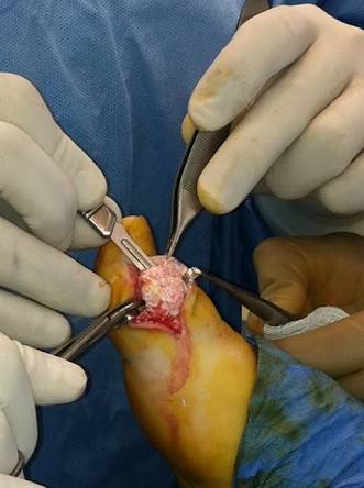 关节炎可以通过打抗生素治疗吗,关节炎治疗的注意事项