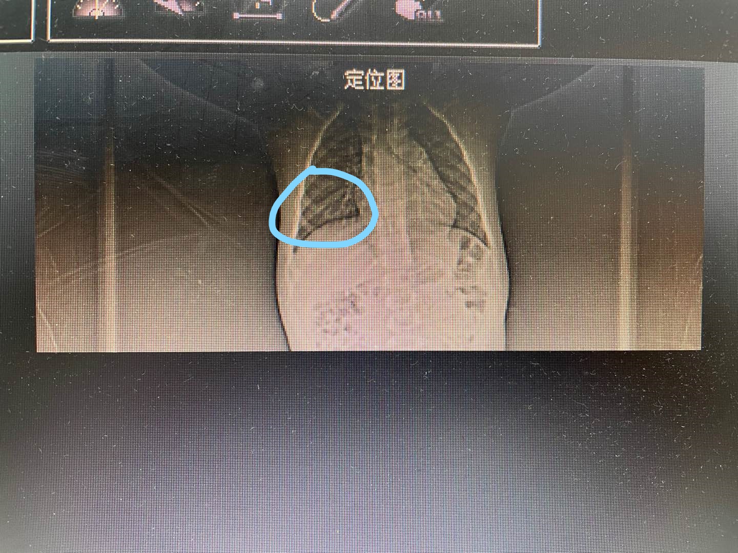 宝宝气管呛到异物反复发烧咳嗽吗,婴幼儿支气管异物咳嗽表现