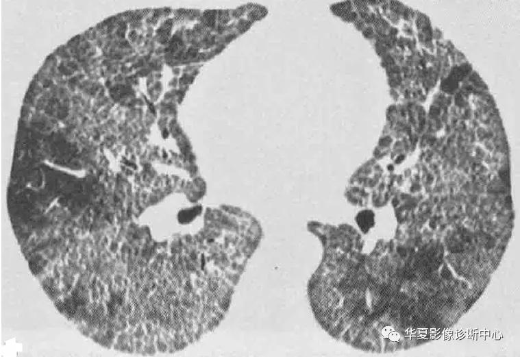 肺部代谢周期是多少天,肺部高代谢病变