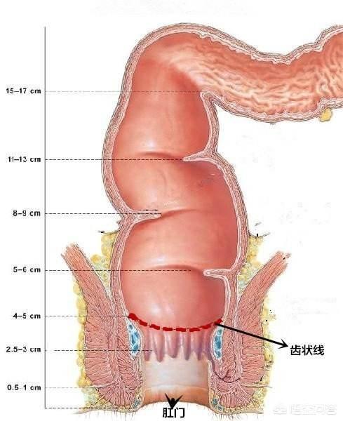 直肠癌吻合口狭窄的症状,直肠癌术后吻合口狭窄什么原因