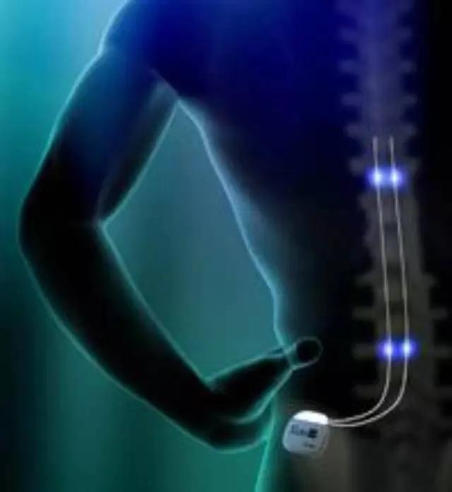 脊髓电刺激治疗带状疱疹手术,带状疱疹脊髓电刺激植入术