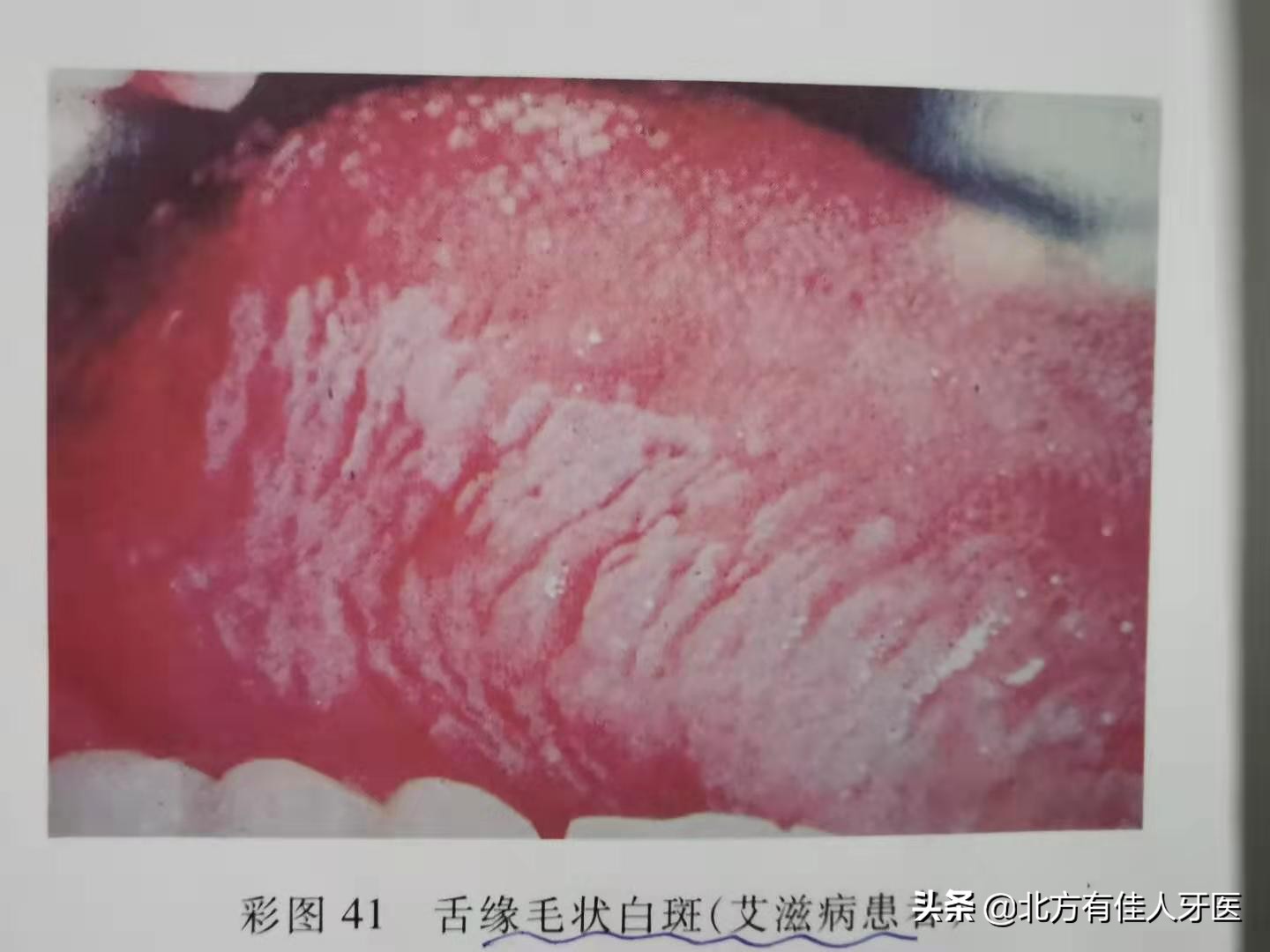 一张嘴就能看出是否得艾滋病，你知道怎么诊断和鉴别诊断吗？