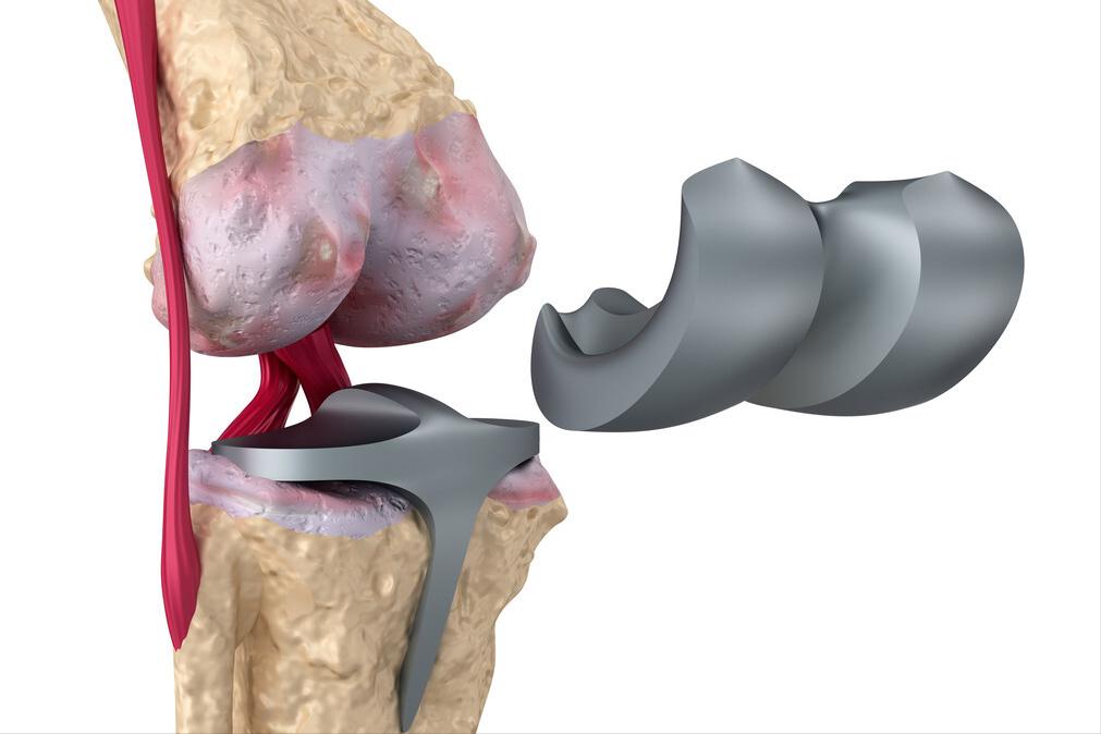 软骨损伤膝关节炎最好治疗方法,膝关节骨性关节炎修补