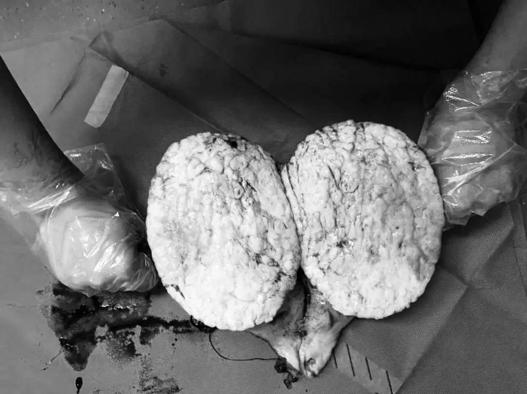 肚子大以为是胖却患肿瘤,以为自己胖其实是囊肿