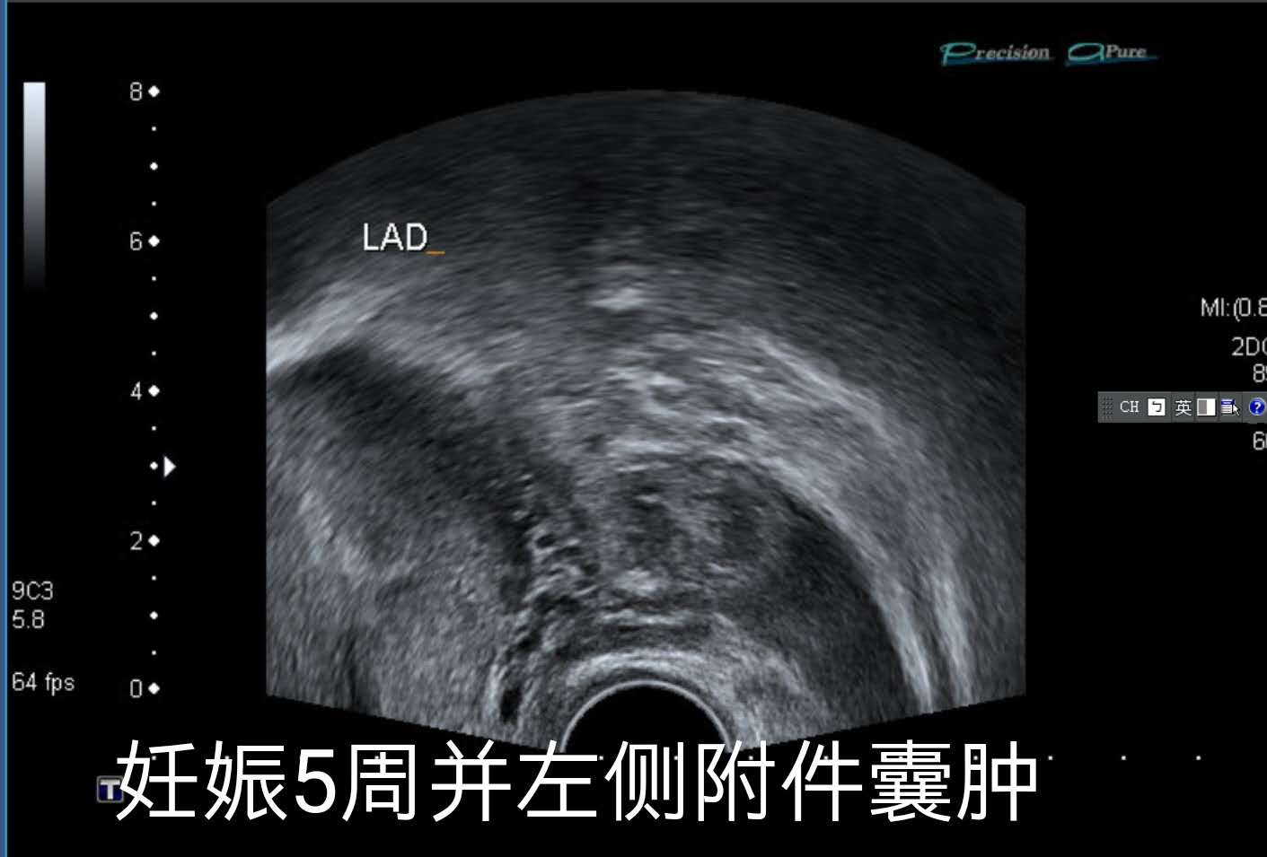 双胞胎一个宫内一个宫外大出血,双胞胎一个流产一个宫外孕