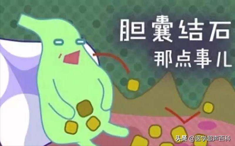 胆结石最简单的解决方法,胆结石只有一个最佳治疗方法