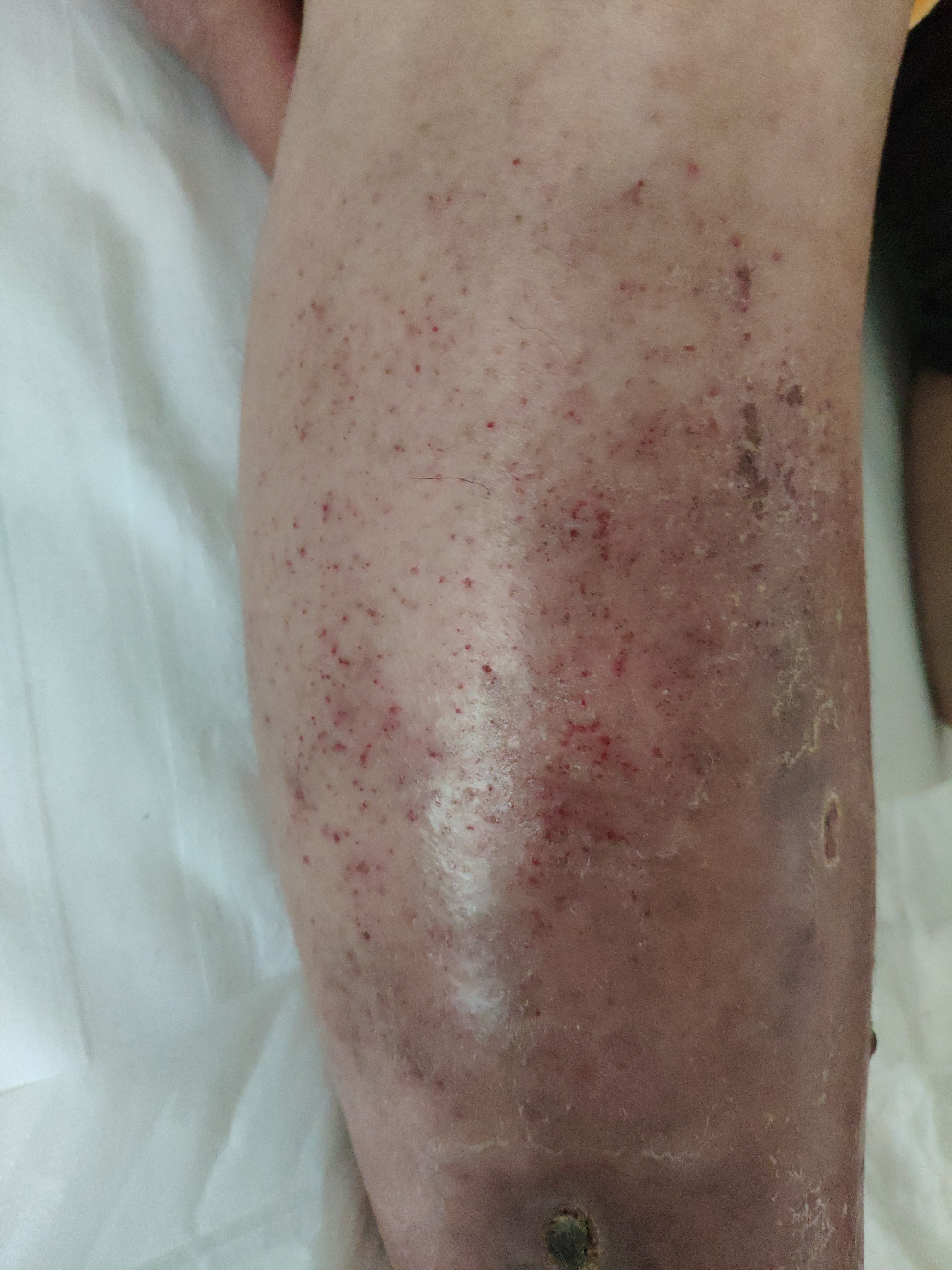 下肢皮肤溃烂吃什么,下肢皮肤瘙痒溃烂