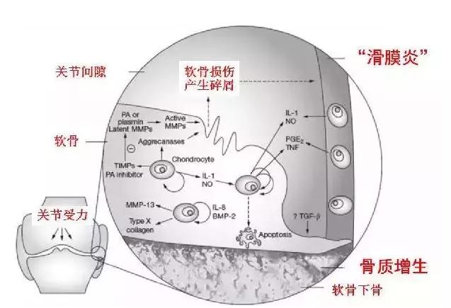 怎么区分关节炎滑膜炎骨质增生,膝关节滑膜炎和骨质增生区别