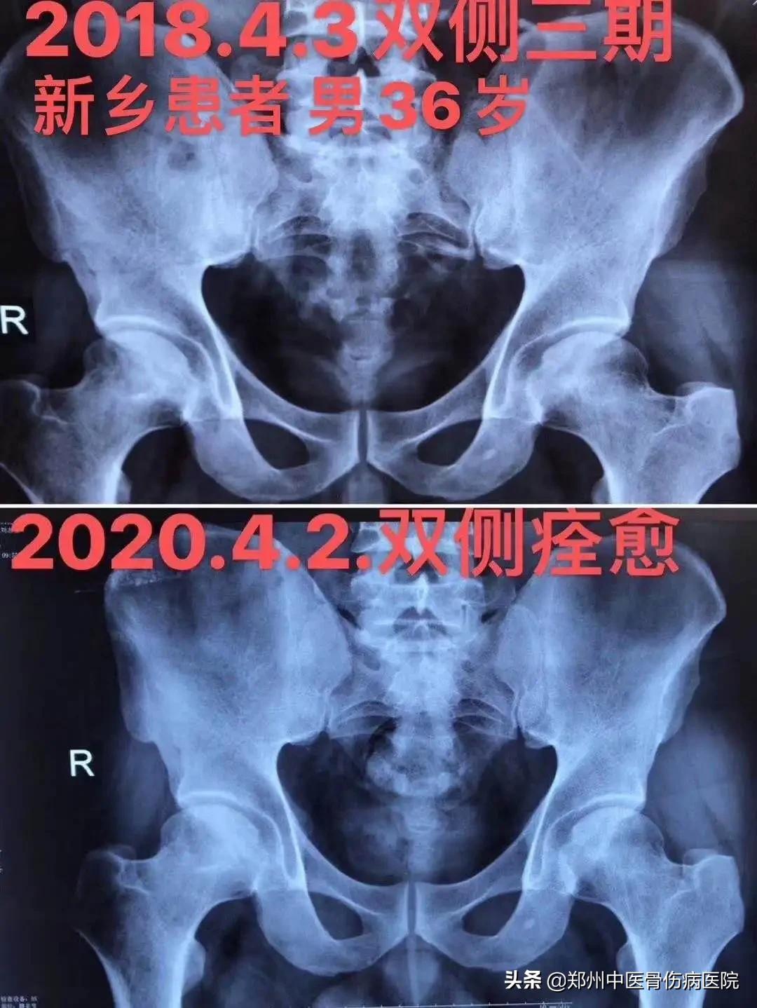 双侧股骨头坏死治愈后,骨坏死半年