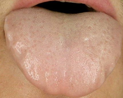 归脾丸吃错了胃胀气,人参归脾丸的四大误区