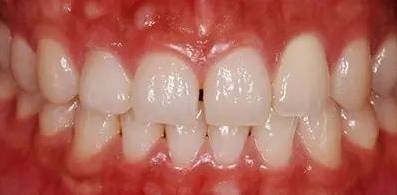 牙缝越来越大是什么导致的,牙缝越来越大什么病中医怎么说