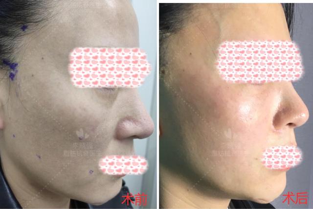 面部凹陷显老怎么整,女生脸部凹陷怎么补救