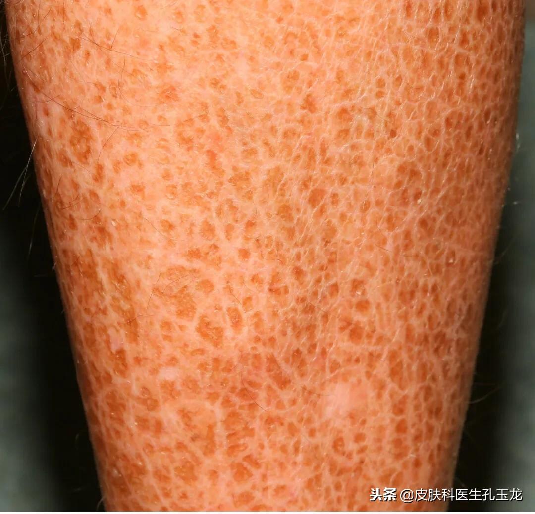 小腿上一小块皮肤病怎么区分,小腿长了一小块类似皮癣的东西