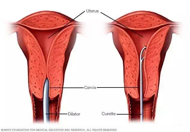 女孩堕胎14次,女子流产4次真相令人唏嘘