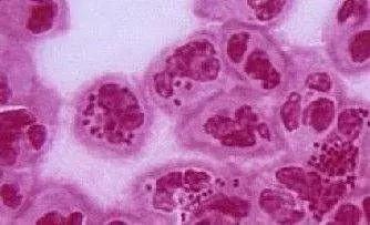 尖锐性湿疣与艾滋病哪个更严重,尖锐性湿疣跟艾滋病有关系吗