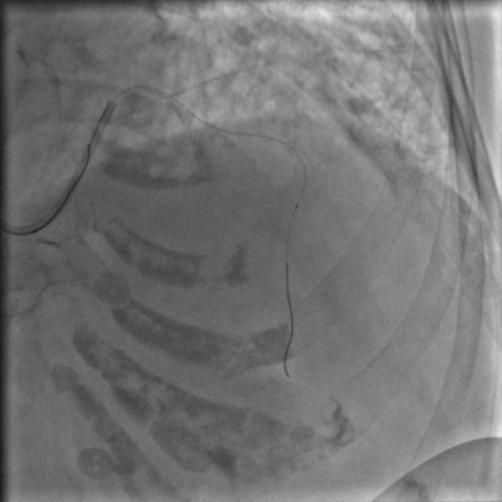 85岁老人心脏堵塞,77岁老人冠脉狭窄放支架还是搭桥
